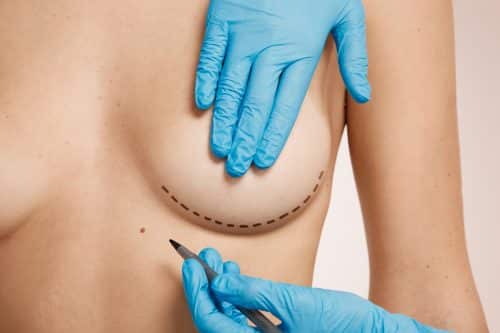 augmentation mammaire Paris